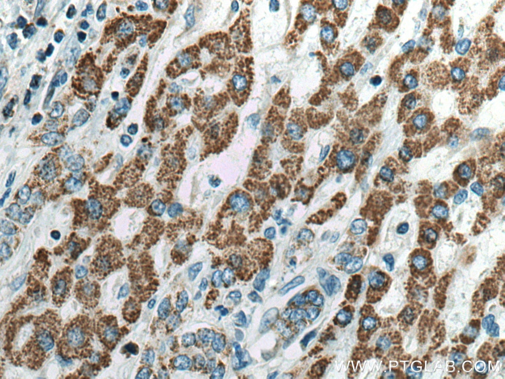 Immunohistochemistry (IHC) staining of human liver cancer tissue using ALDH5A1 Polyclonal antibody (17319-1-AP)