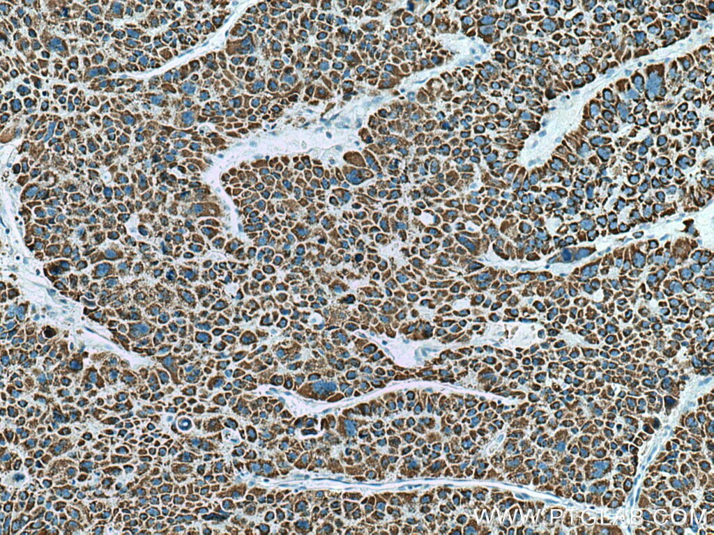 Immunohistochemistry (IHC) staining of human liver cancer tissue using ALDH5A1 Polyclonal antibody (17319-1-AP)