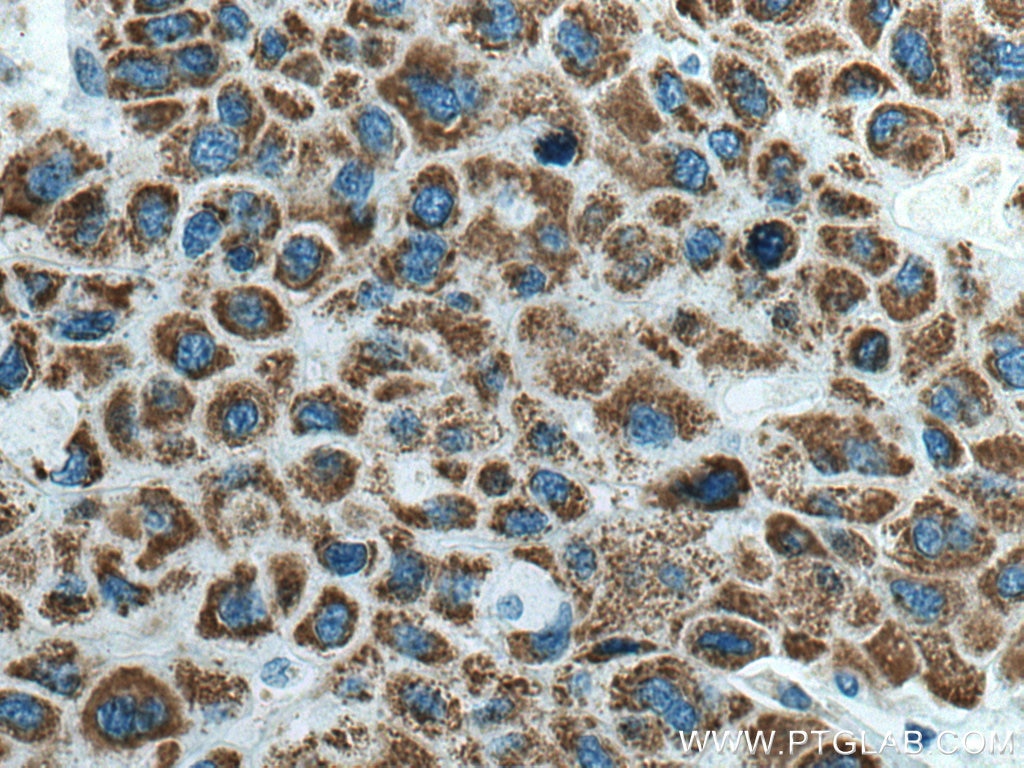 IHC staining of human liver cancer using 17319-1-AP