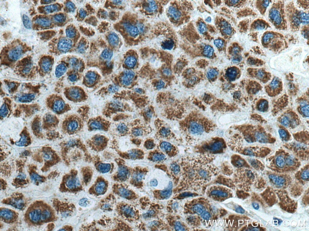 Immunohistochemistry (IHC) staining of human liver cancer tissue using ALDH5A1 Polyclonal antibody (17319-1-AP)