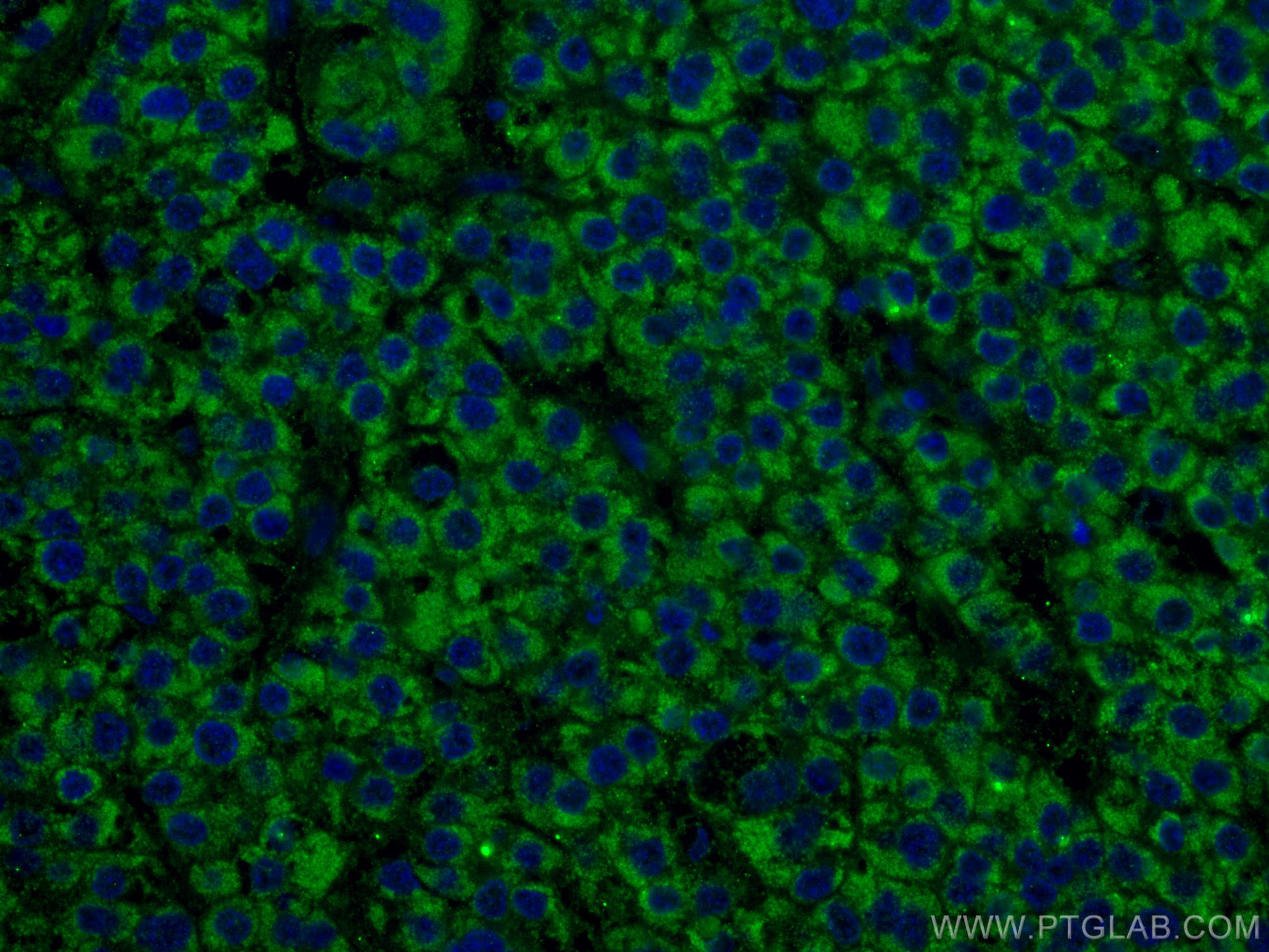 Immunofluorescence (IF) / fluorescent staining of human liver cancer tissue using ALDH5A1 Monoclonal antibody (67347-1-Ig)