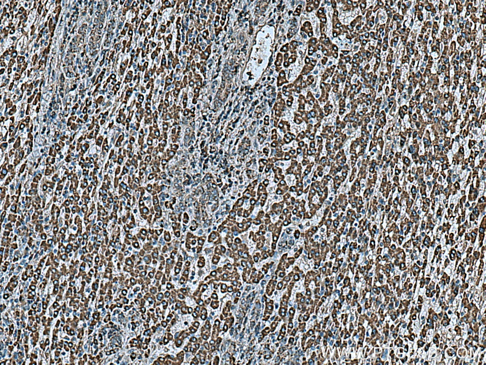 IHC staining of human liver cancer using 67347-1-Ig