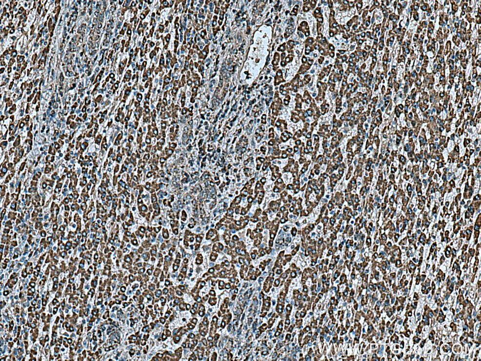 Immunohistochemistry (IHC) staining of human liver cancer tissue using ALDH5A1 Monoclonal antibody (67347-1-Ig)