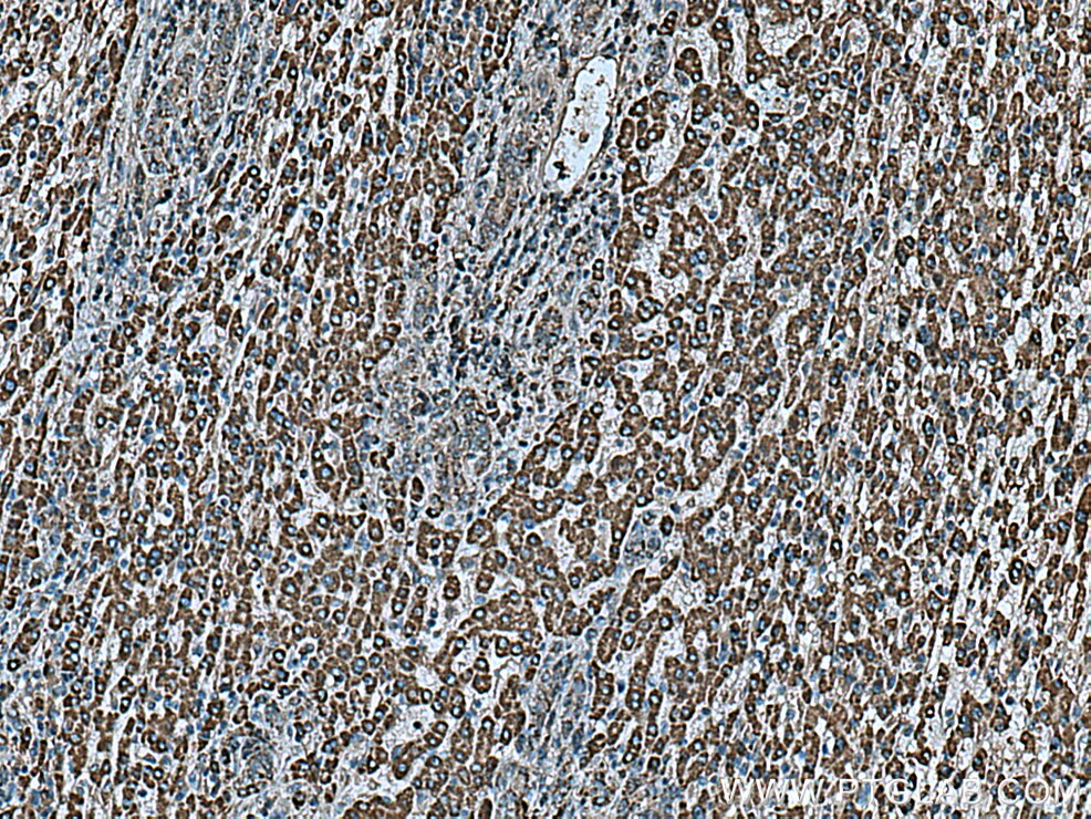 Immunohistochemistry (IHC) staining of human liver cancer tissue using ALDH5A1 Monoclonal antibody (67347-1-Ig)