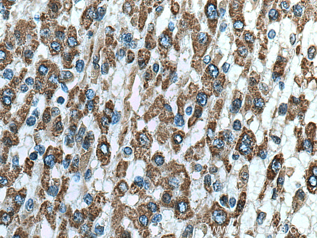 Immunohistochemistry (IHC) staining of human liver cancer tissue using ALDH5A1 Monoclonal antibody (67347-1-Ig)