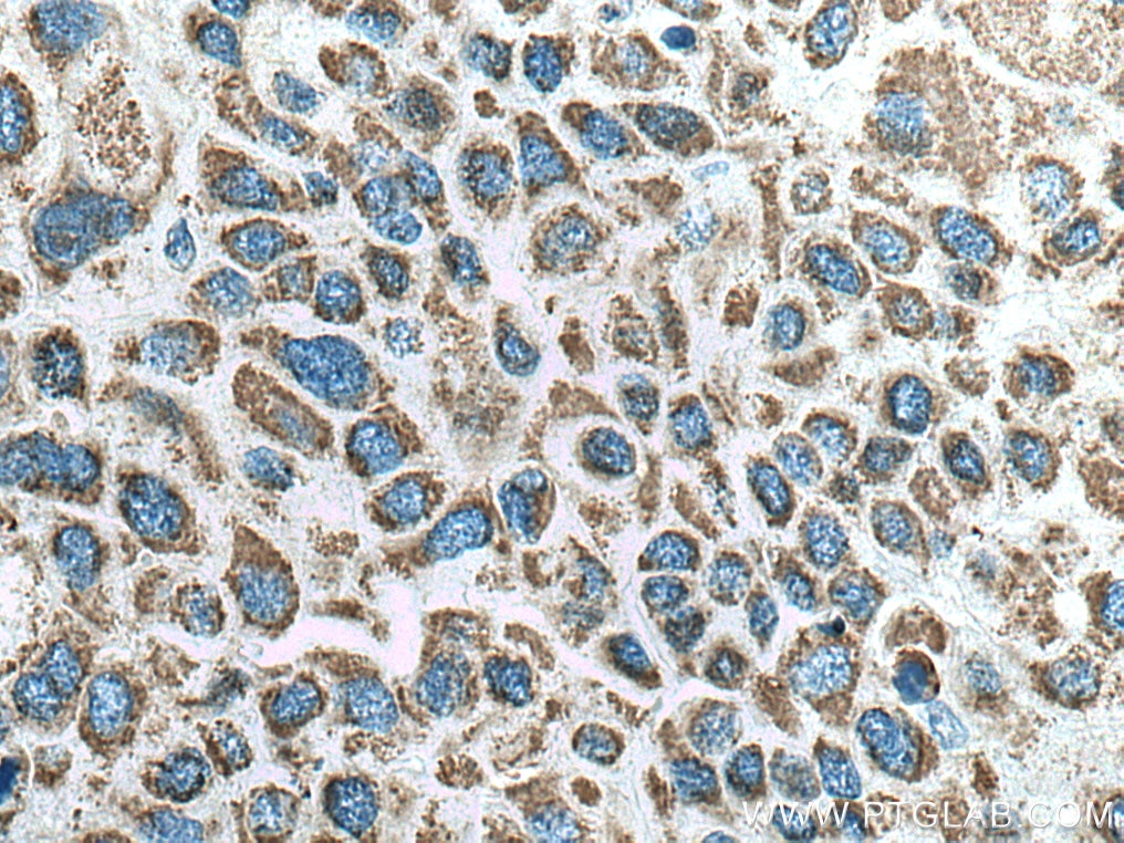 Immunohistochemistry (IHC) staining of human liver cancer tissue using ALDH5A1 Monoclonal antibody (67347-1-Ig)