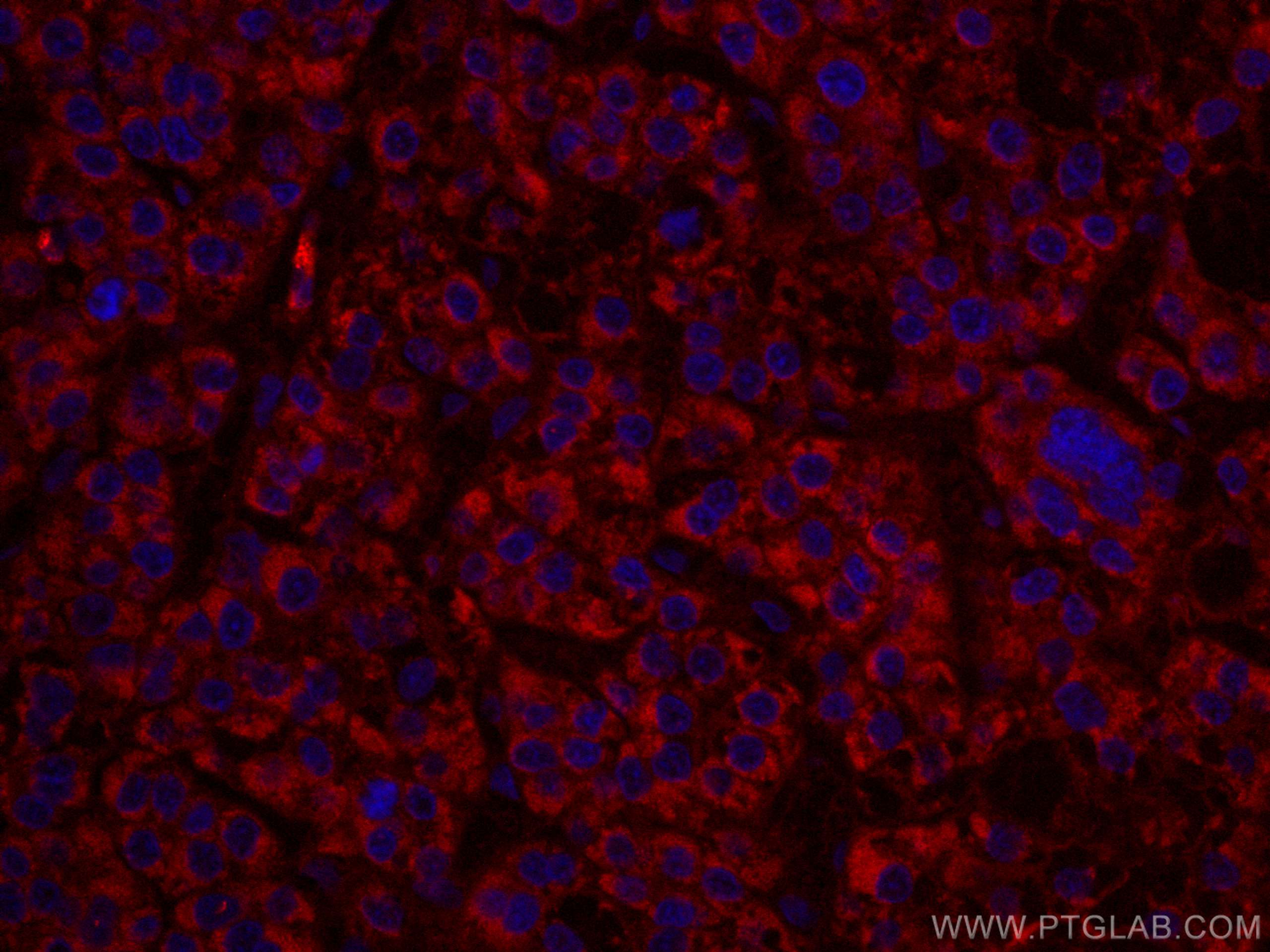 Immunofluorescence (IF) / fluorescent staining of human liver cancer tissue using CoraLite®594-conjugated ALDH5A1 Monoclonal antibod (CL594-67347)