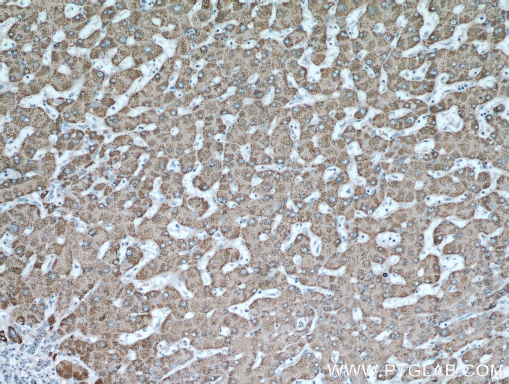 Immunohistochemistry (IHC) staining of human hepatocirrhosis tissue using ALDH6A1 Polyclonal antibody (20452-1-AP)