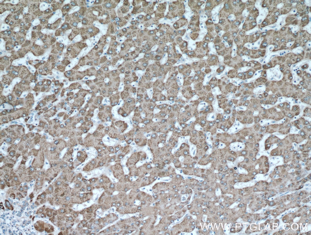 Immunohistochemistry (IHC) staining of human hepatocirrhosis tissue using ALDH6A1 Polyclonal antibody (20452-1-AP)