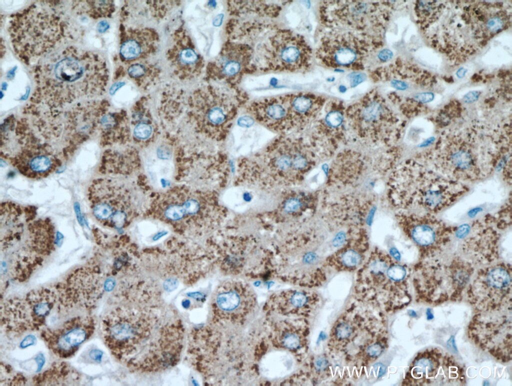 Immunohistochemistry (IHC) staining of human hepatocirrhosis tissue using ALDH6A1 Polyclonal antibody (20452-1-AP)