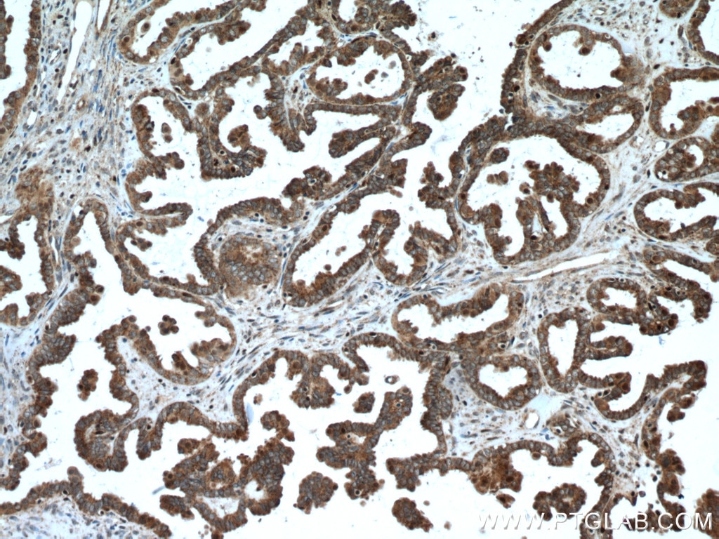 Immunohistochemistry (IHC) staining of human ovary tumor tissue using ALDH7A1 Polyclonal antibody (10368-1-AP)