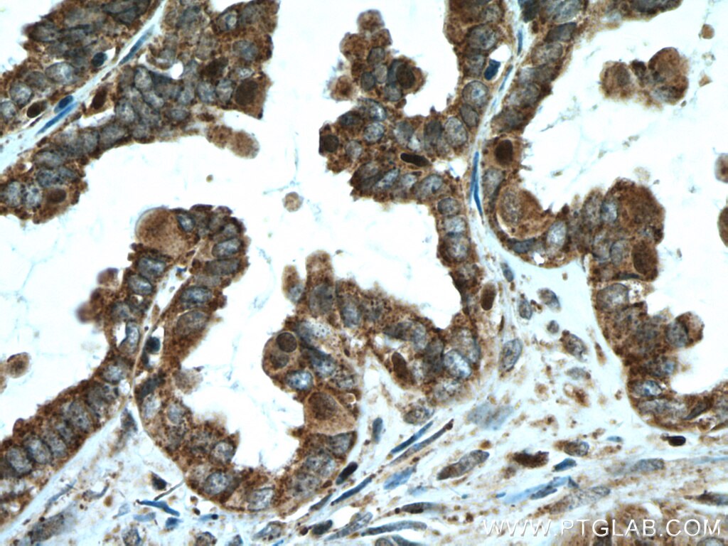 Immunohistochemistry (IHC) staining of human ovary tumor tissue using ALDH7A1 Polyclonal antibody (10368-1-AP)
