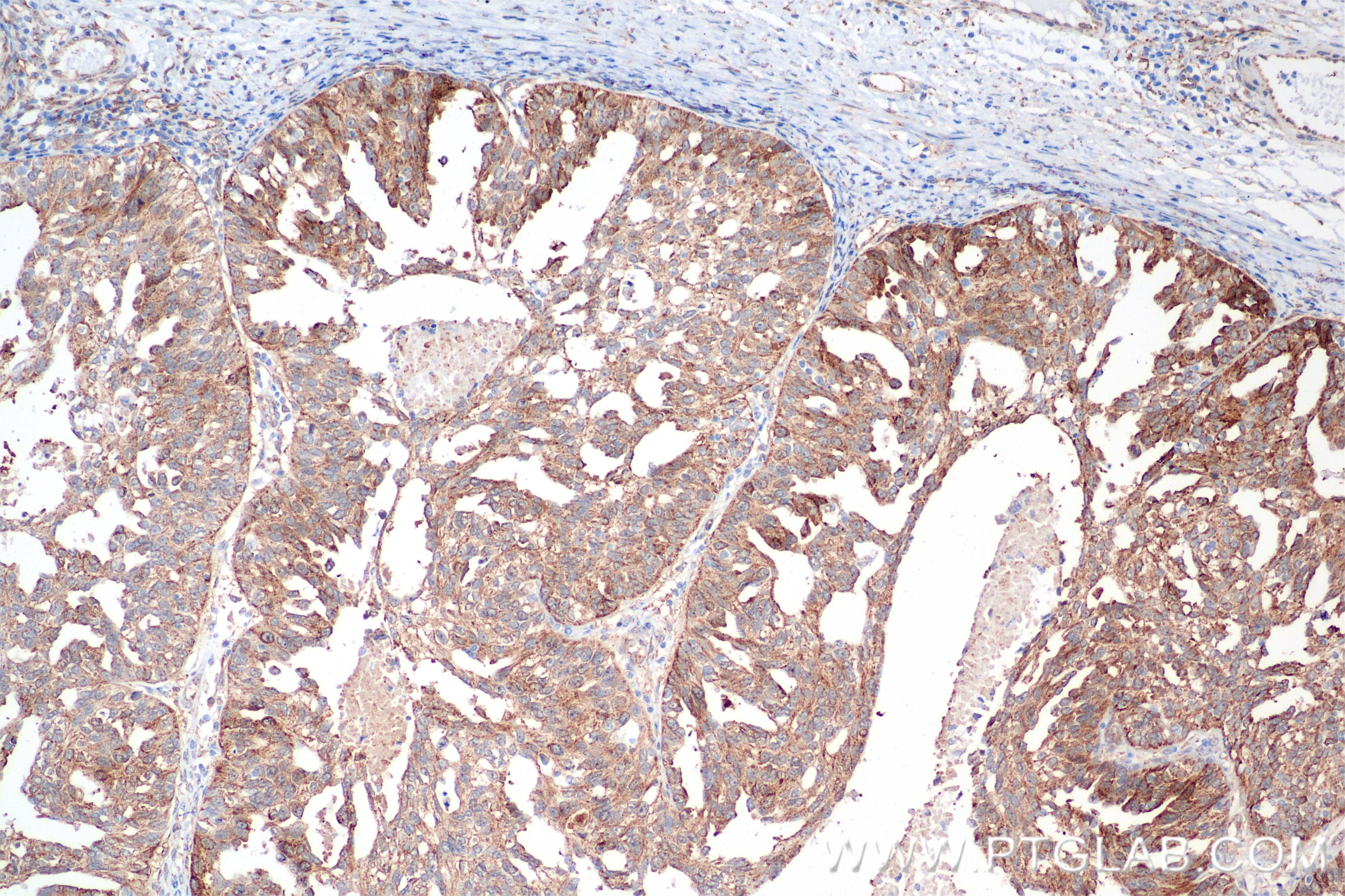 Immunohistochemistry (IHC) staining of human ovary cancer tissue using ALDH7A1 Recombinant antibody (84871-4-RR)