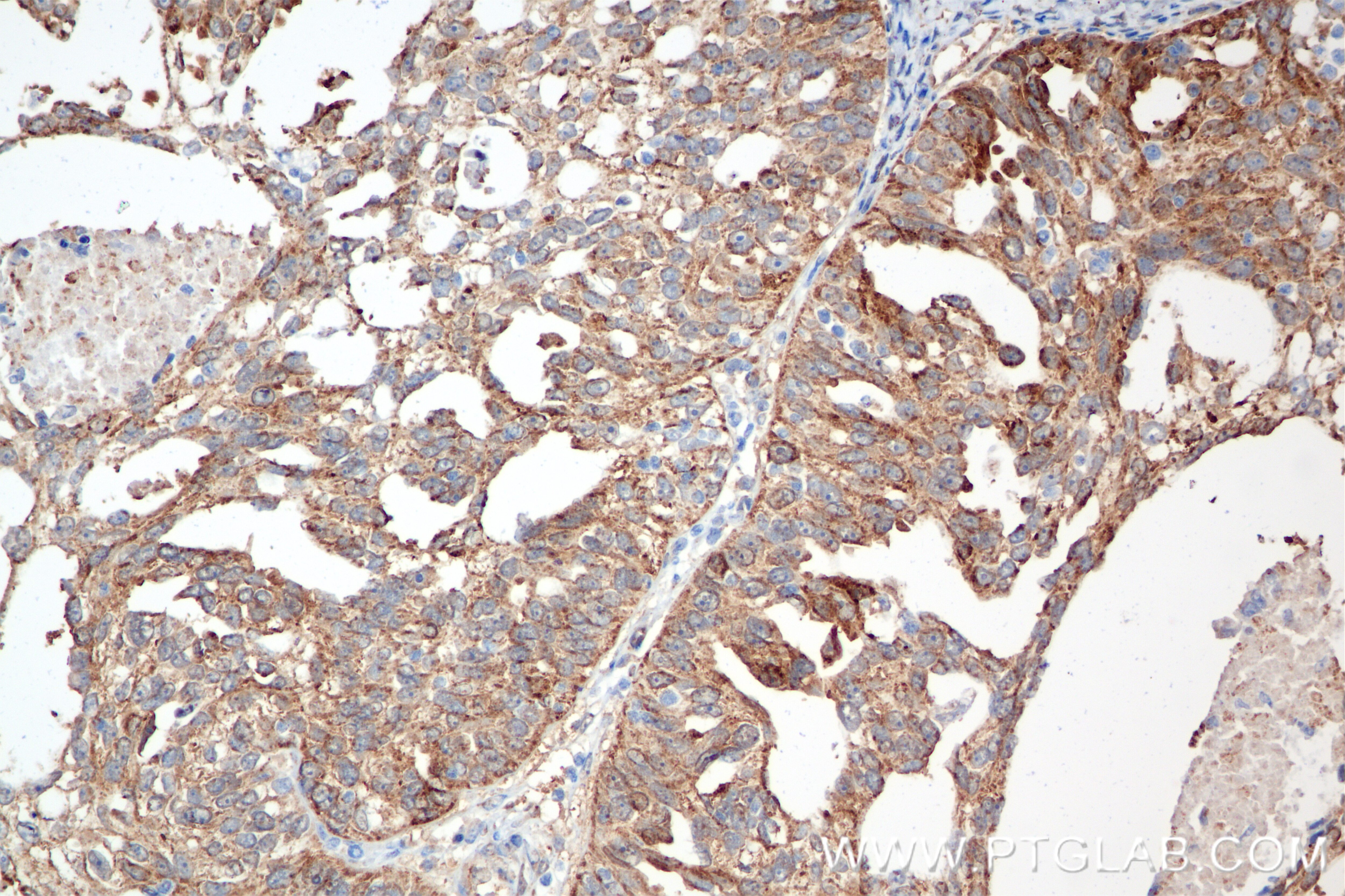 Immunohistochemistry (IHC) staining of human ovary cancer tissue using ALDH7A1 Recombinant antibody (84871-4-RR)