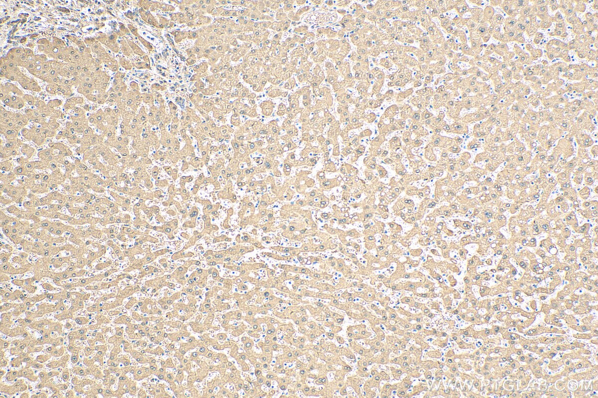 Immunohistochemistry (IHC) staining of human hepatocirrhosis tissue using ALDH8A1 Polyclonal antibody (21602-1-AP)