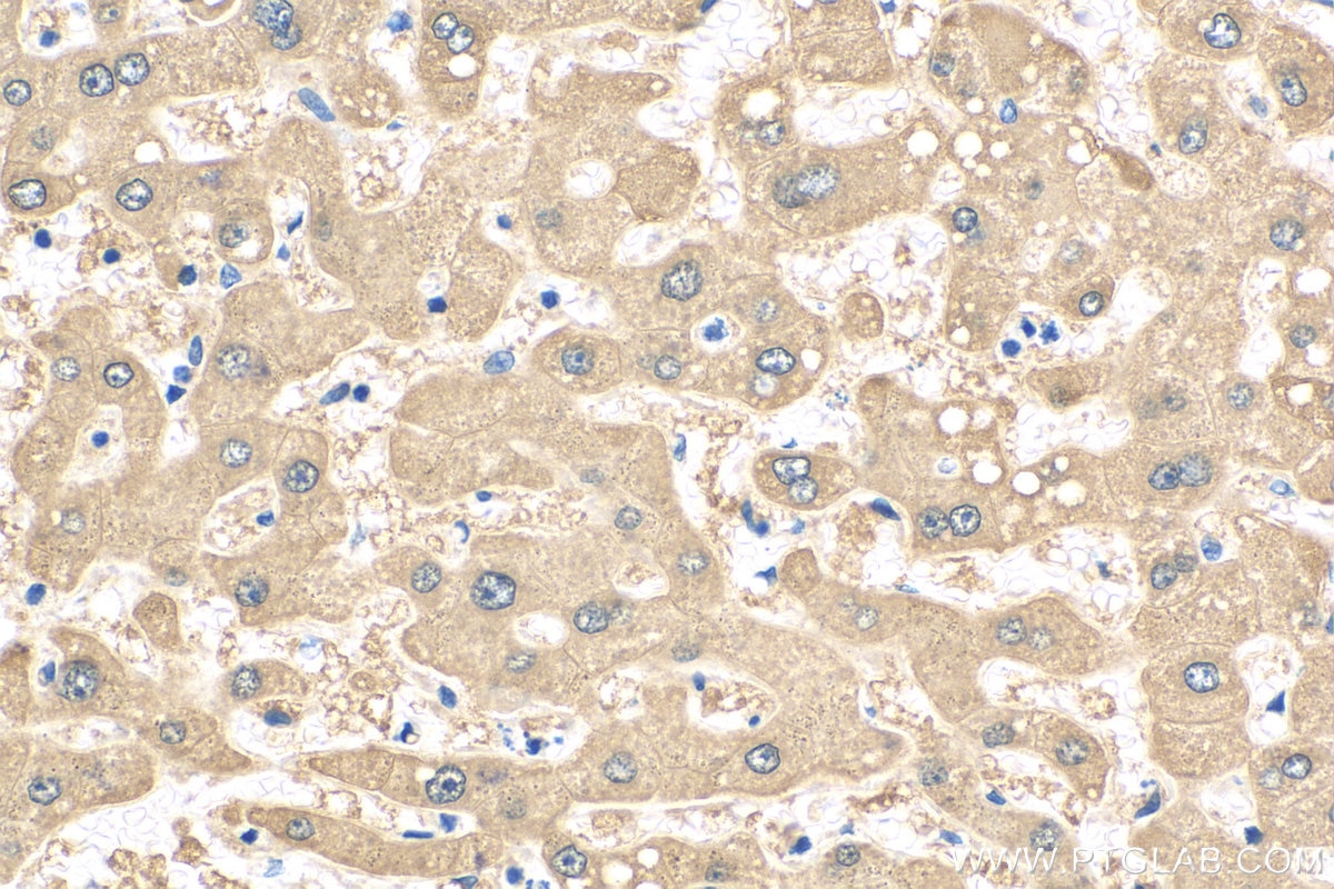 Immunohistochemistry (IHC) staining of human hepatocirrhosis tissue using ALDH8A1 Polyclonal antibody (21602-1-AP)