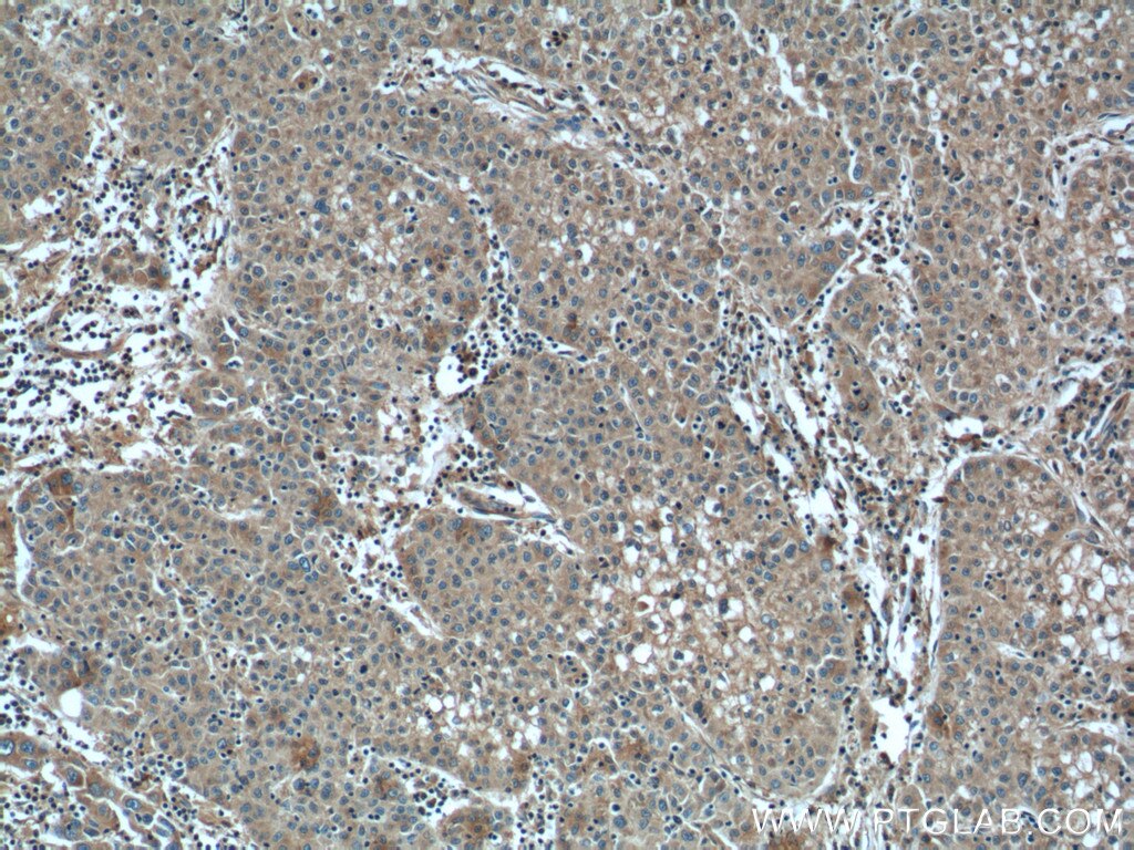 Immunohistochemistry (IHC) staining of human liver cancer tissue using ALDH9A1 Polyclonal antibody (26621-1-AP)