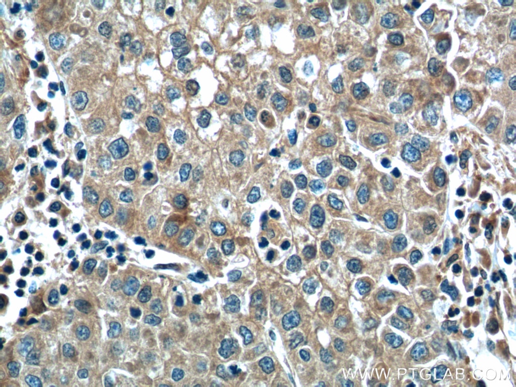 Immunohistochemistry (IHC) staining of human liver cancer tissue using ALDH9A1 Polyclonal antibody (26621-1-AP)
