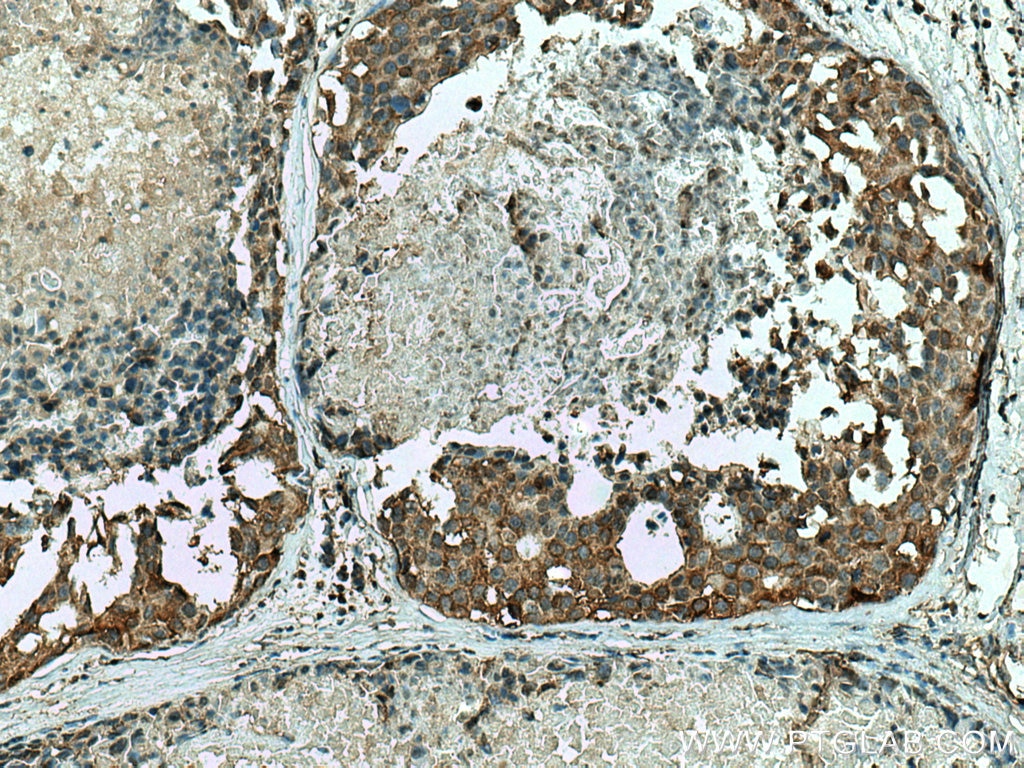 Immunohistochemistry (IHC) staining of human breast cancer tissue using ALDH9A1 Monoclonal antibody (67372-1-Ig)