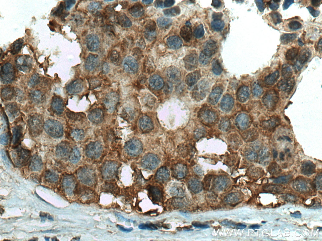 Immunohistochemistry (IHC) staining of human breast cancer tissue using ALDH9A1 Monoclonal antibody (67372-1-Ig)