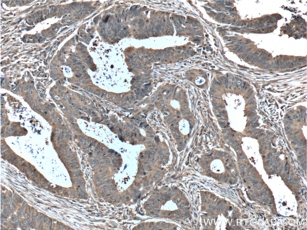 Immunohistochemistry (IHC) staining of human colon cancer tissue using ALDOA Polyclonal antibody (11217-1-AP)