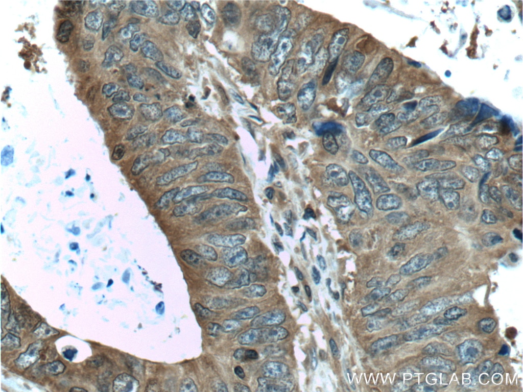 Immunohistochemistry (IHC) staining of human colon cancer tissue using ALDOA Polyclonal antibody (11217-1-AP)