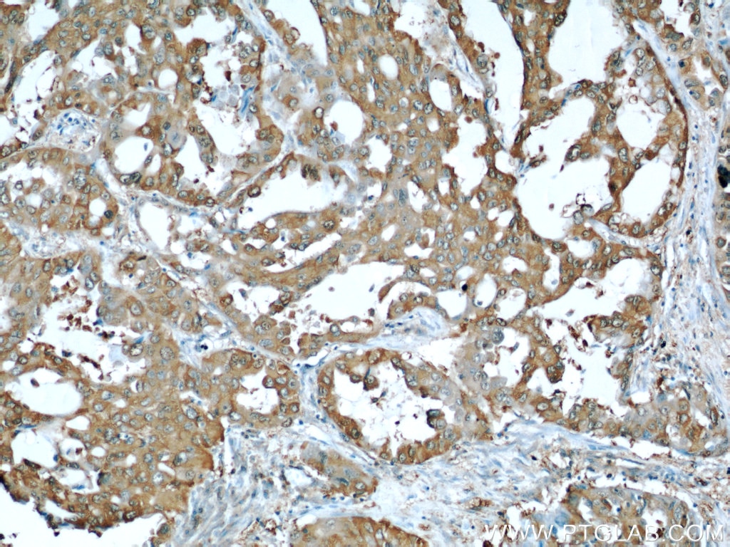 Immunohistochemistry (IHC) staining of human lung cancer tissue using ALDOA Polyclonal antibody (11217-1-AP)