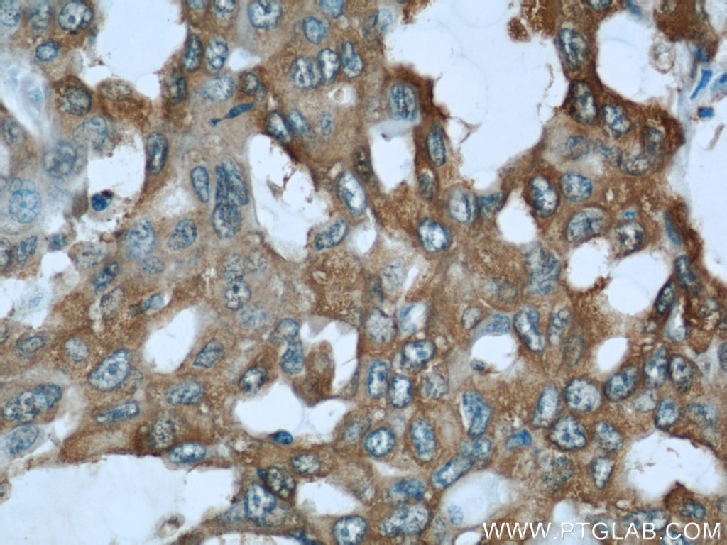Immunohistochemistry (IHC) staining of human lung cancer tissue using ALDOA Polyclonal antibody (11217-1-AP)
