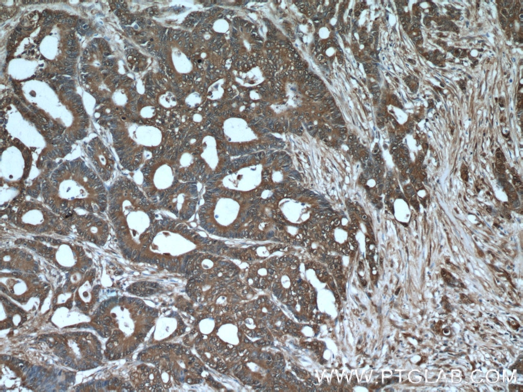 Immunohistochemistry (IHC) staining of human colon cancer tissue using ALDOA Polyclonal antibody (11217-1-AP)