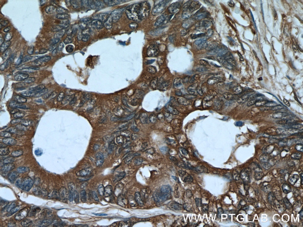 IHC staining of human colon cancer using 11217-1-AP