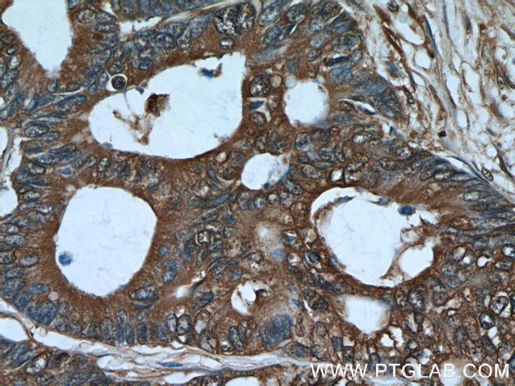 Immunohistochemistry (IHC) staining of human colon cancer tissue using ALDOA Polyclonal antibody (11217-1-AP)