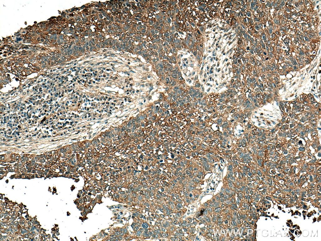 Immunohistochemistry (IHC) staining of human lung cancer tissue using ALDOA Monoclonal antibody (67453-1-Ig)