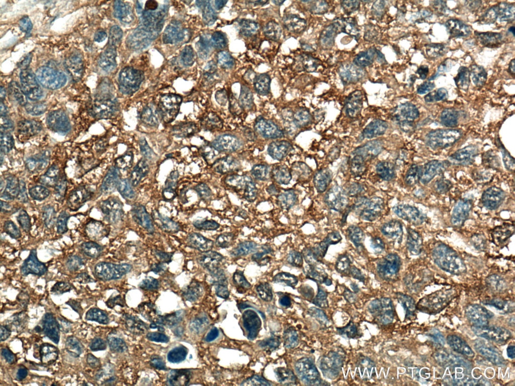 Immunohistochemistry (IHC) staining of human lung cancer tissue using ALDOA Monoclonal antibody (67453-1-Ig)
