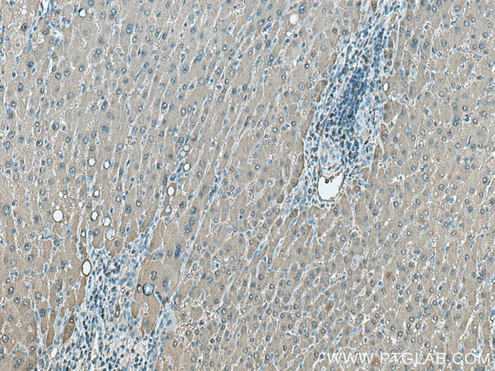 IHC staining of human liver cancer using 18065-1-AP