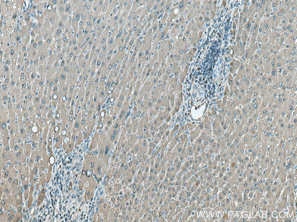 Immunohistochemistry (IHC) staining of human liver cancer tissue using ALDOB Polyclonal antibody (18065-1-AP)