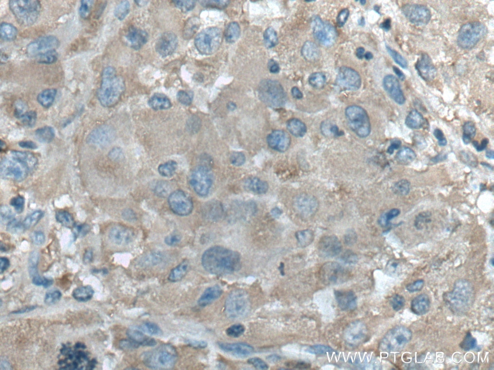 Immunohistochemistry (IHC) staining of human liver cancer tissue using ALDOB Polyclonal antibody (18065-1-AP)