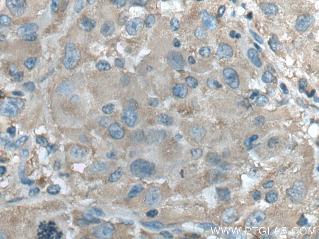 IHC staining of human liver cancer using 18065-1-AP