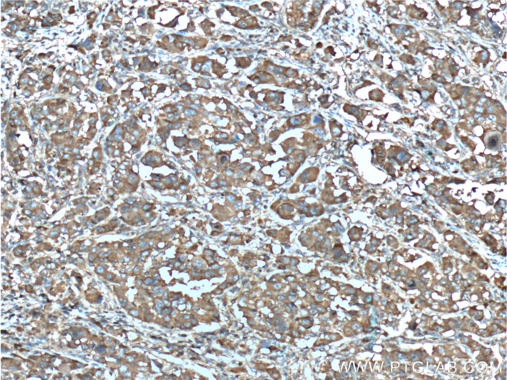 Immunohistochemistry (IHC) staining of human liver cancer tissue using Aldolase C Monoclonal antibody (66120-1-Ig)