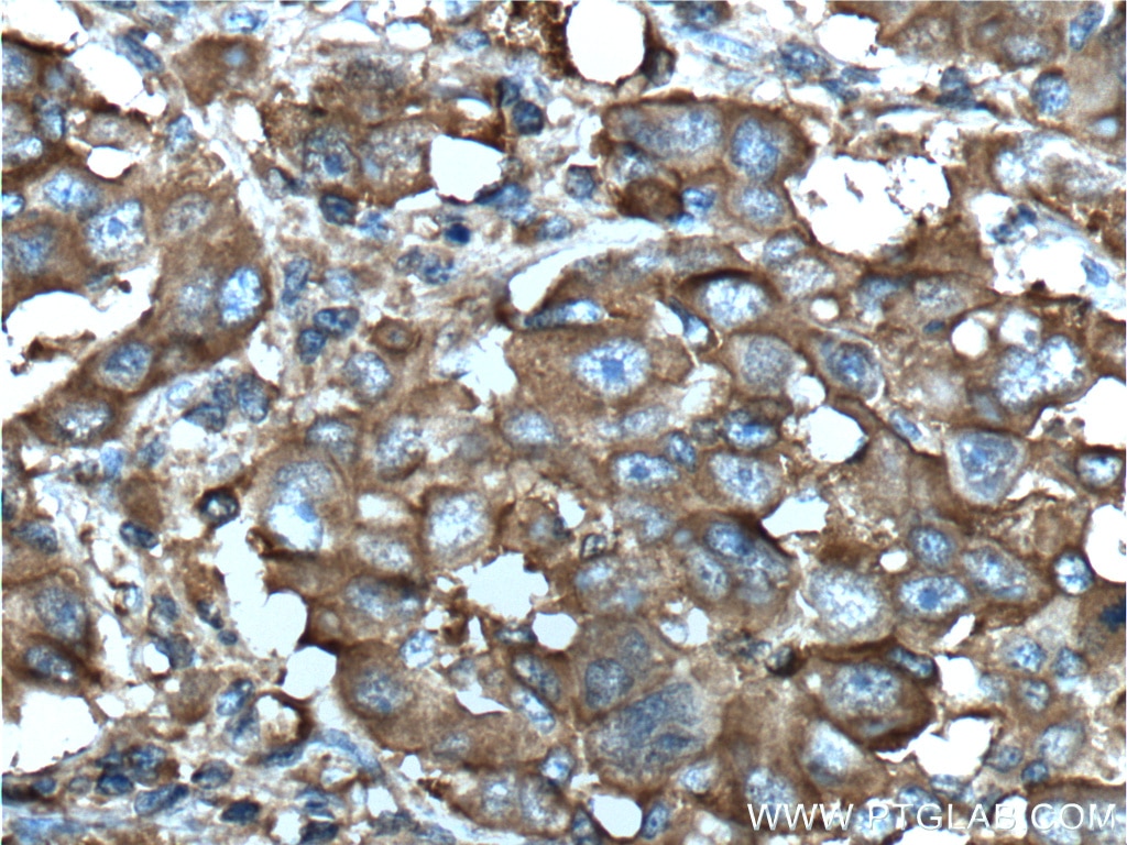 Immunohistochemistry (IHC) staining of human liver cancer tissue using Aldolase C Monoclonal antibody (66120-1-Ig)