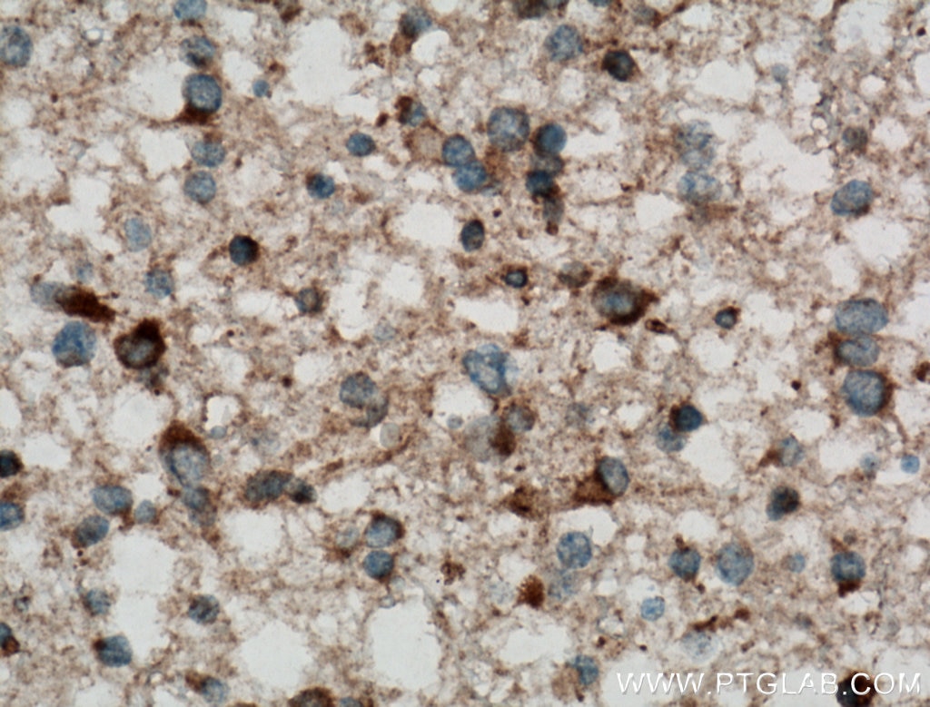 Immunohistochemistry (IHC) staining of human gliomas tissue using ALG1 Polyclonal antibody (12872-1-AP)