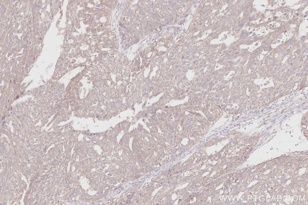Immunohistochemistry (IHC) staining of human ovary cancer tissue using ALG1 Polyclonal antibody (12872-1-AP)