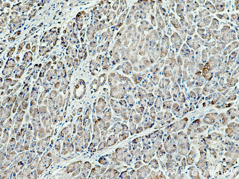 IHC staining of human pancreas cancer using 15092-1-AP