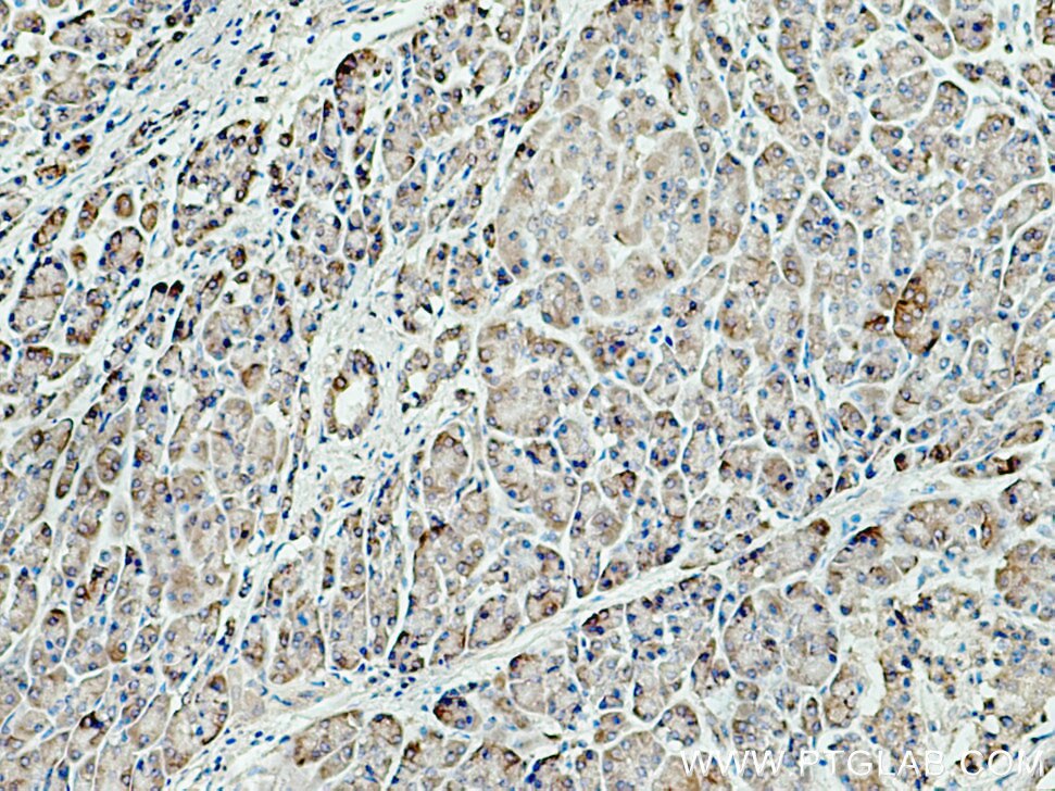 Immunohistochemistry (IHC) staining of human pancreas cancer tissue using ALG2 Polyclonal antibody (15092-1-AP)