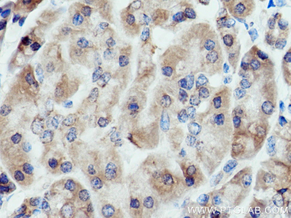 Immunohistochemistry (IHC) staining of human pancreas cancer tissue using ALG2 Polyclonal antibody (15092-1-AP)
