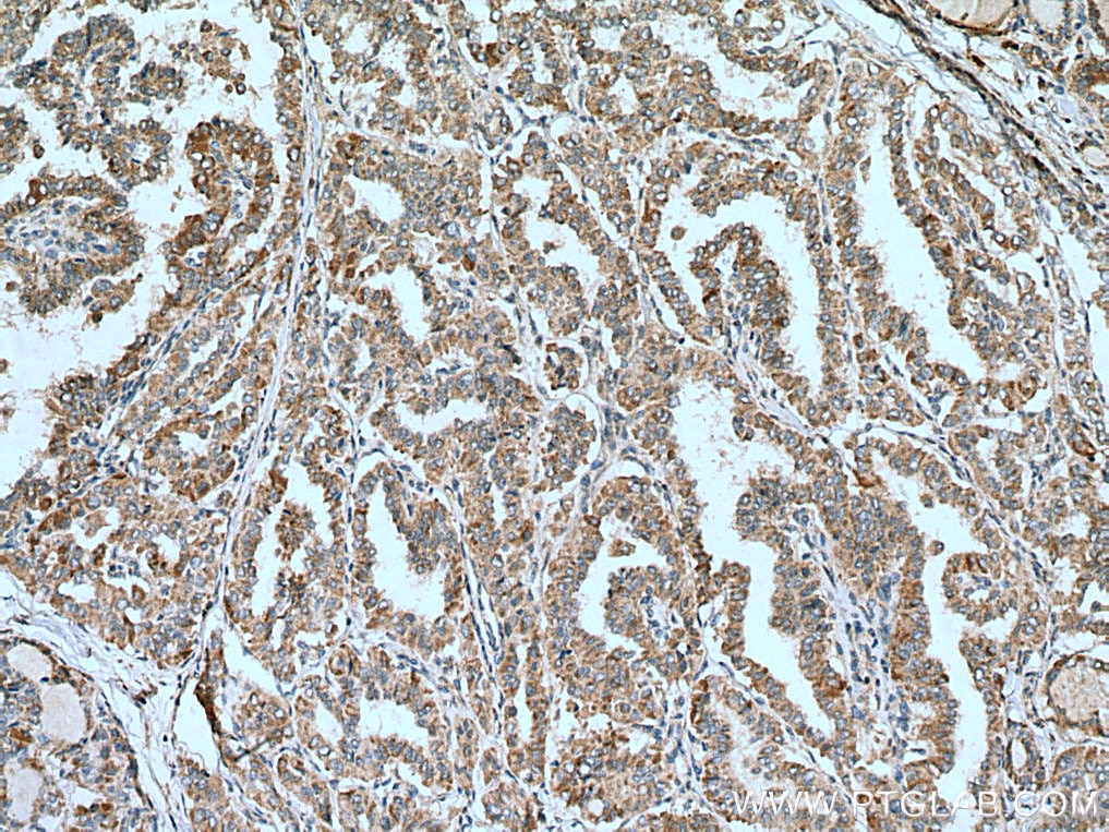 Immunohistochemistry (IHC) staining of human thyroid cancer tissue using ALG3 Polyclonal antibody (20290-1-AP)