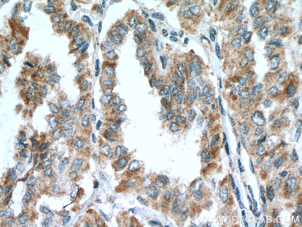 Immunohistochemistry (IHC) staining of human thyroid cancer tissue using ALG3 Polyclonal antibody (20290-1-AP)
