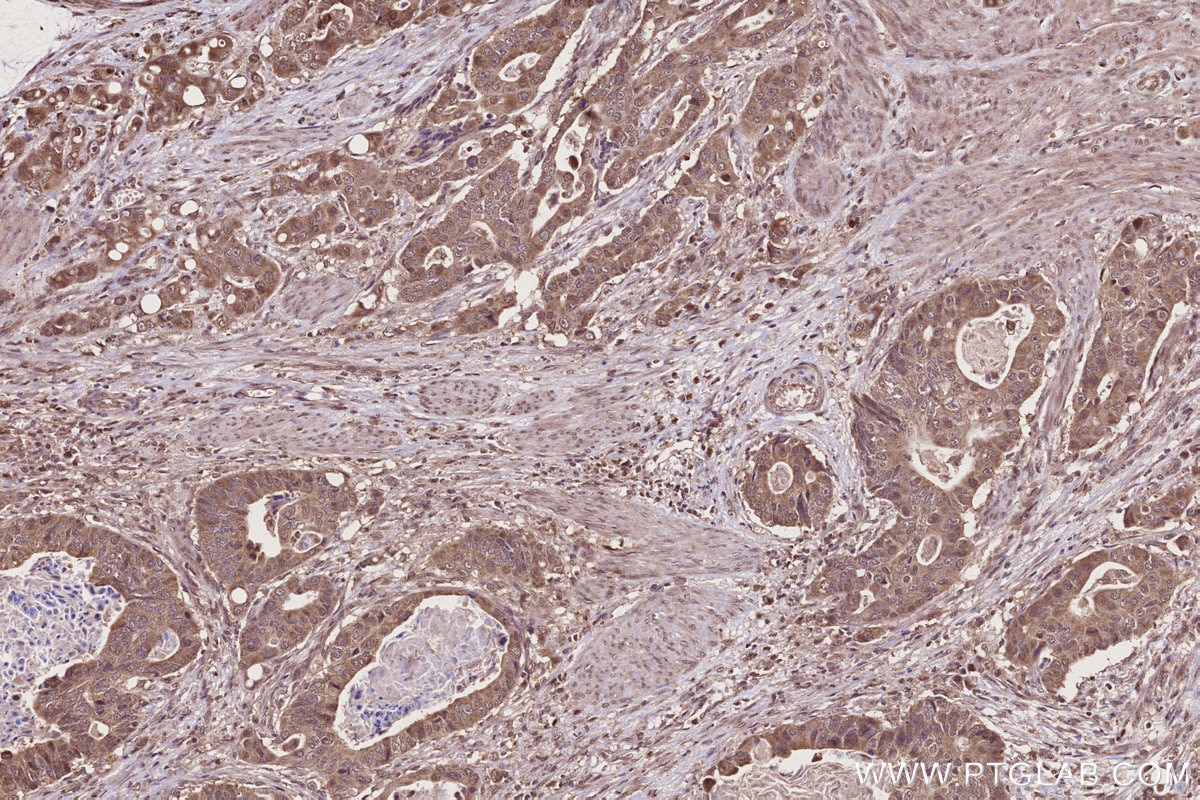 IHC staining of human stomach cancer using 28084-1-AP Immunohistochemistry (IHC) staining of human stomach cancer tissue using ALG3 Polyclonal antibody (28084-1-AP)