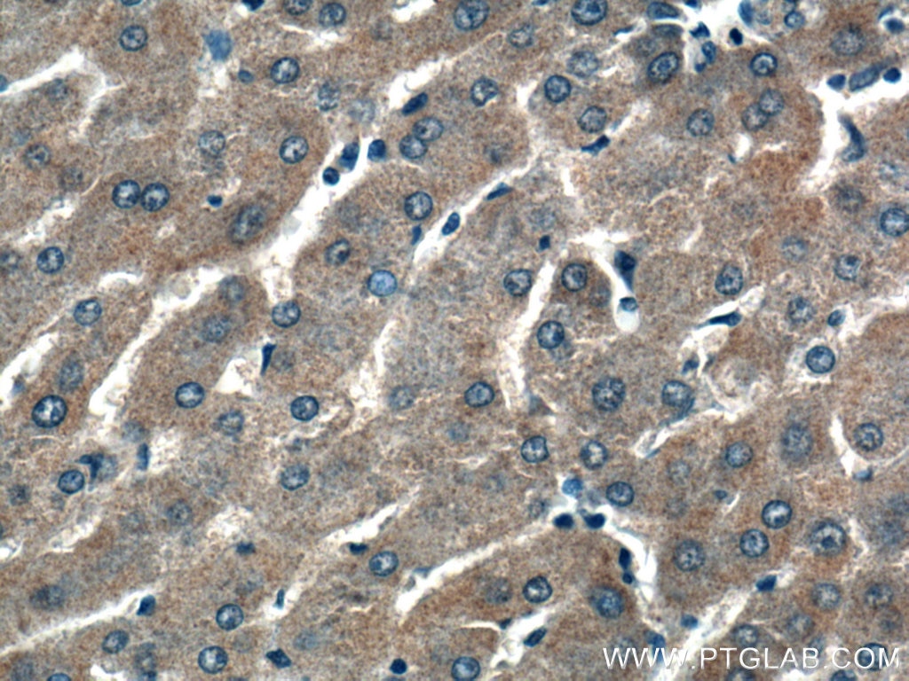 Immunohistochemistry (IHC) staining of human liver cancer tissue using ALG5 Polyclonal antibody (16046-1-AP)