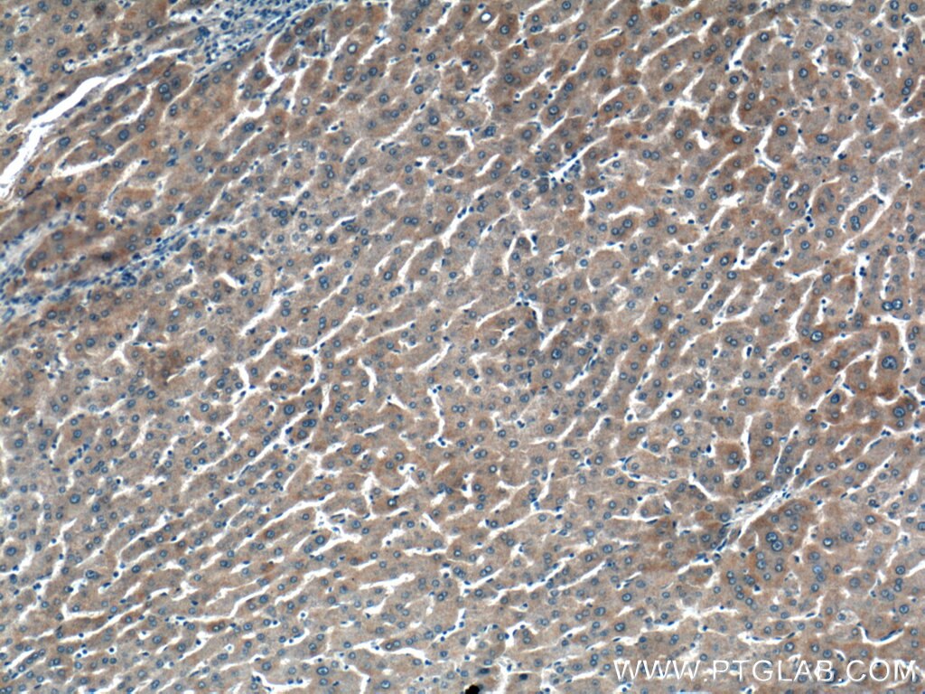 Immunohistochemistry (IHC) staining of human liver cancer tissue using ALG5 Polyclonal antibody (16046-1-AP)