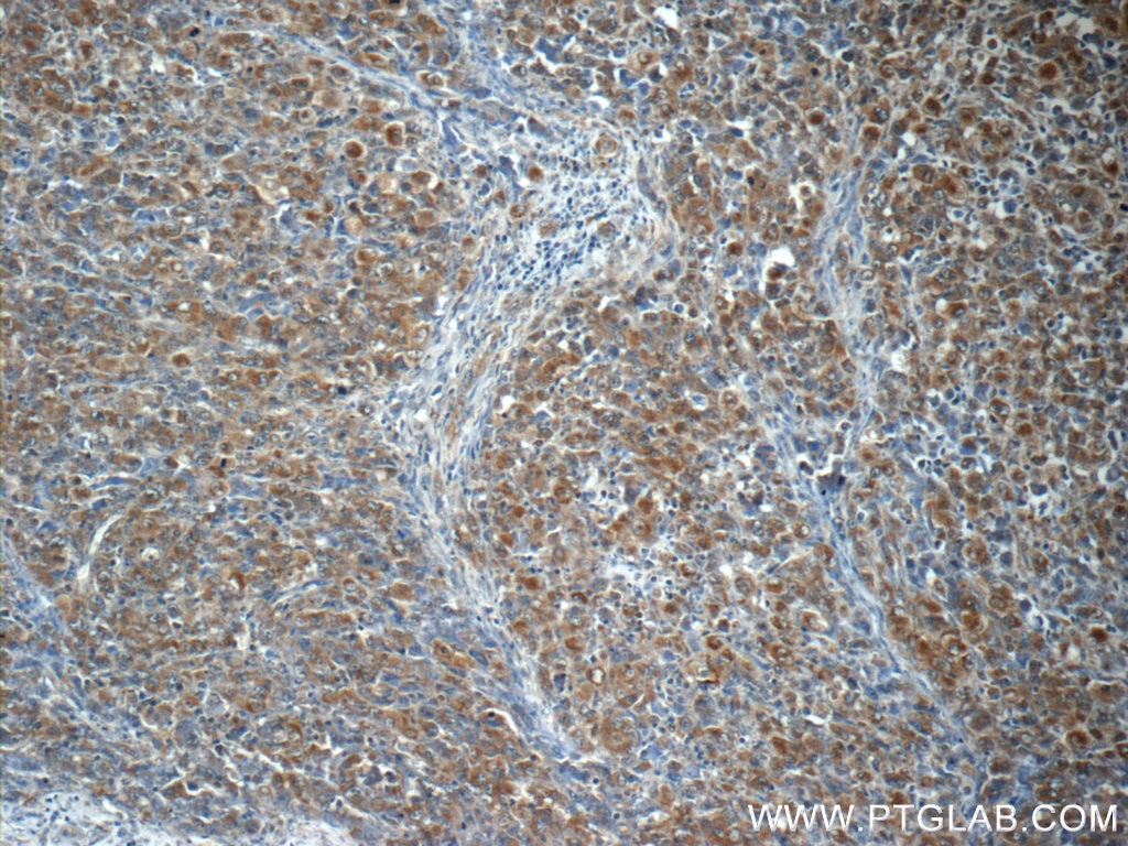 Immunohistochemistry (IHC) staining of human lymphoma tissue using ALK Polyclonal antibody (24184-1-AP)